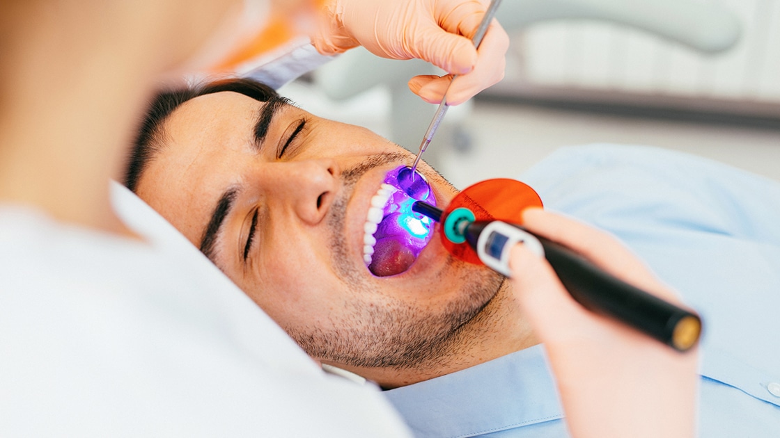 Dental Sealants Procedure